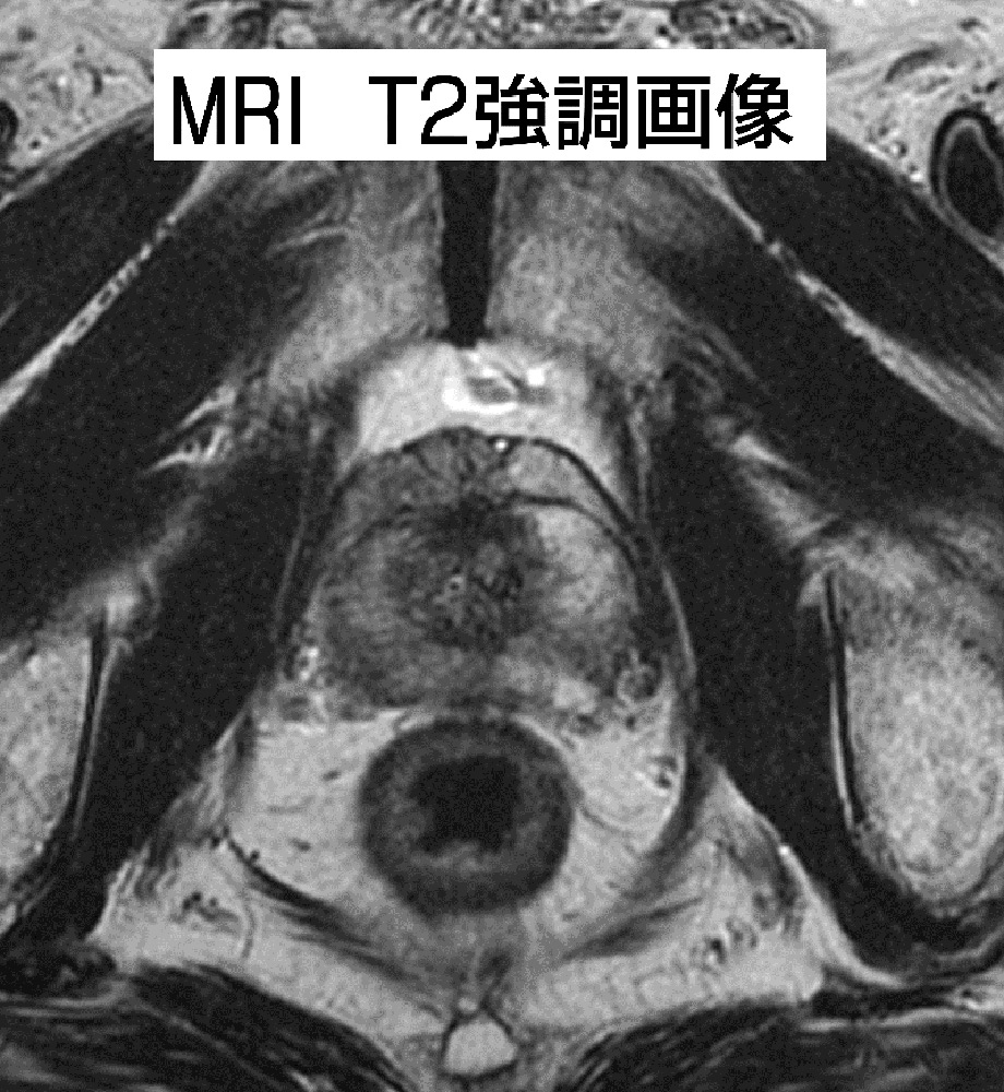 MRI T2協調画像