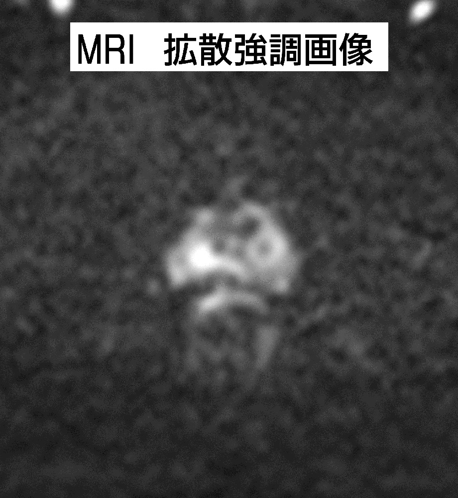 MRI 拡散協調画像