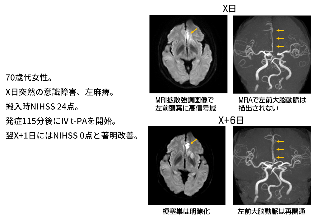 IV t-PAが著効した脳塞栓症の1例