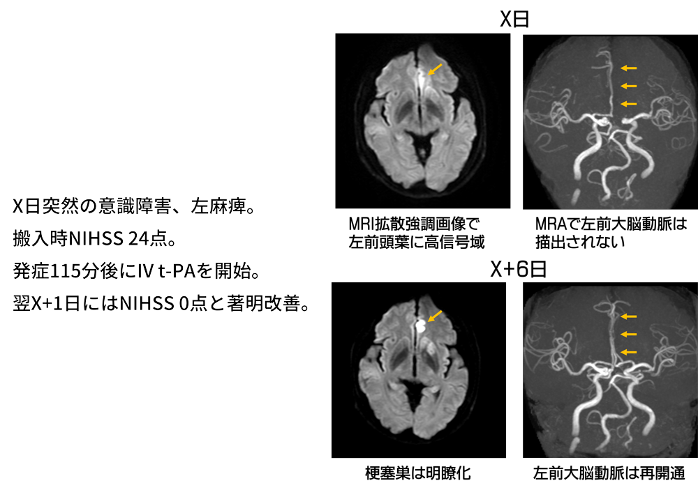 IV t-PAが著効した脳塞栓症の1例