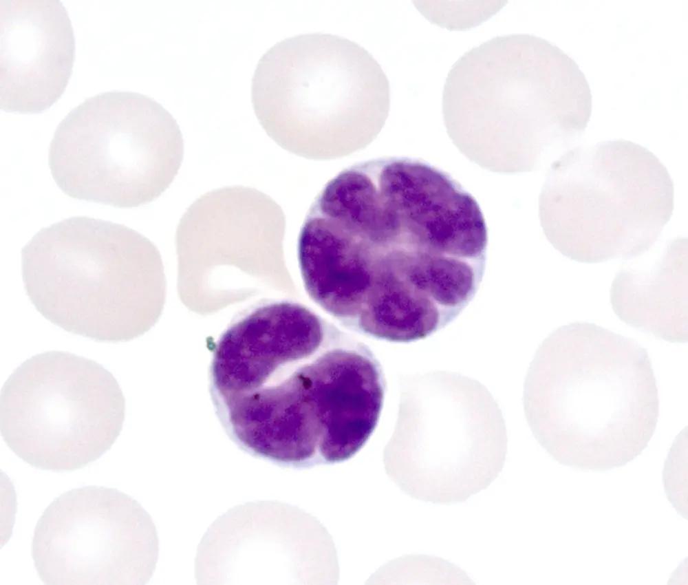 末梢血中のATL細胞